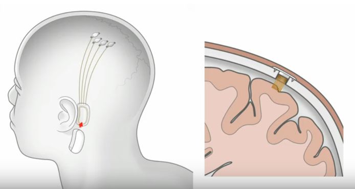 শিগগিরই মানবদেহে বসানো হবে নিউরালিংকের পরীক্ষামূলক চিপ